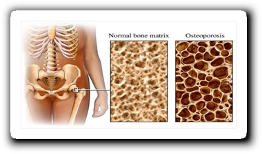 osteoporosis-1