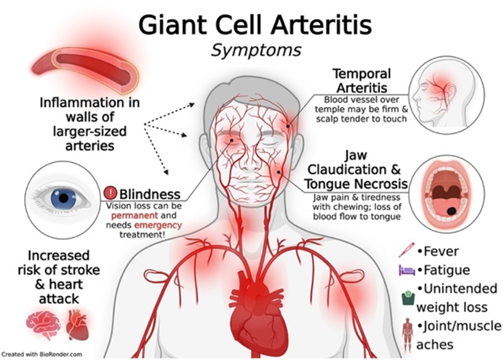 Giant Cell Arteritis Alberta Rheumatology 5237